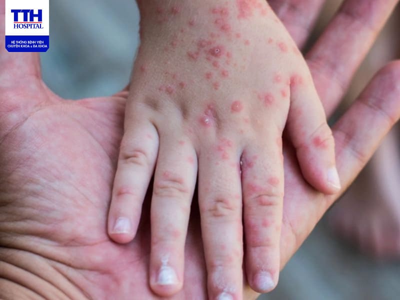 Bệnh sởi có mức độ lây lan rất cao, chủ yếu qua đường hô hấp của trẻ