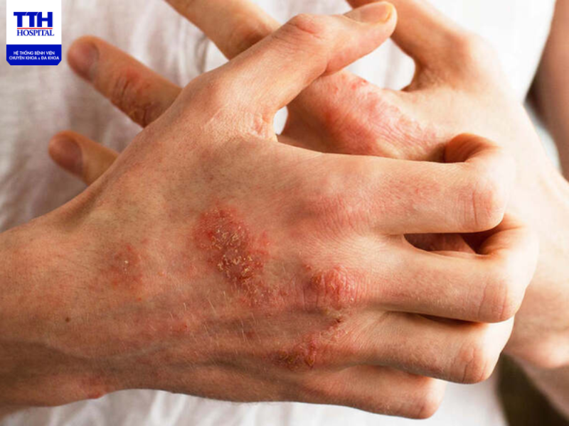 Eczema là một thể bệnh gồm một nhóm các bệnh ngoài da