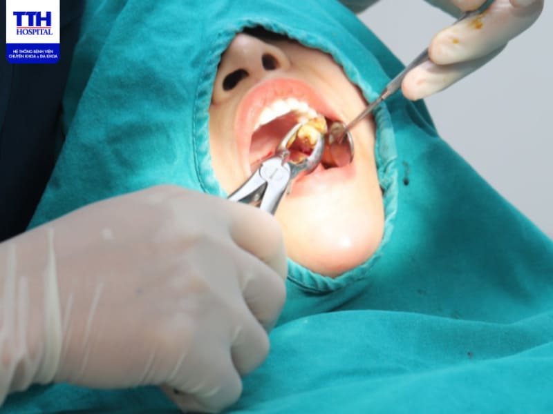 Khi nào cần nhổ răng khôn