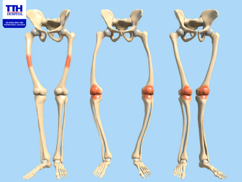 Còi xương là một dạng rối loạn thường gặp ở trẻ em