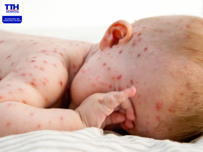 Bệnh sởi làm cho bé khó chịu, dễ bỏ ăn và quấy khóc