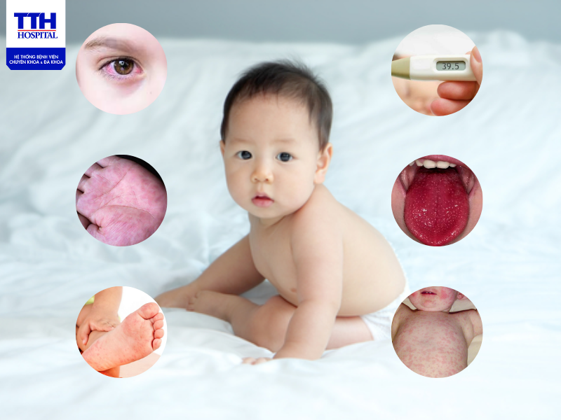 Bệnh Kawasaki thường gặp phổ biến ở trẻ em