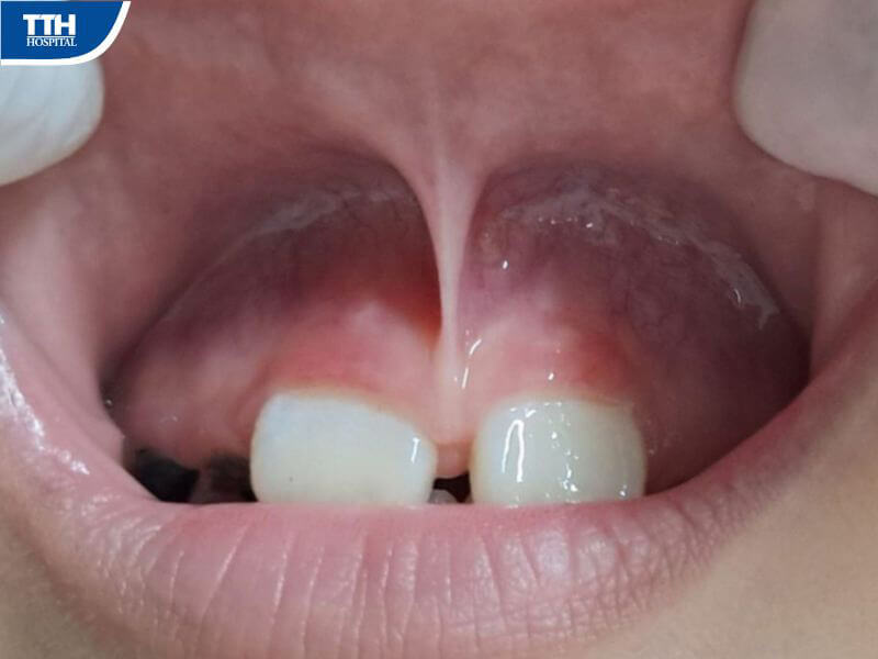 Cách chữa trị dính thắng môi cho trẻ em