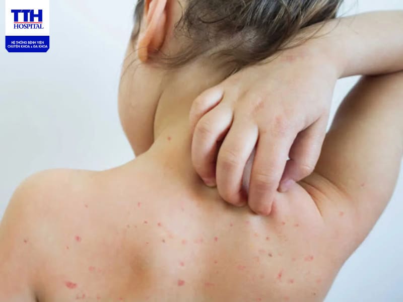 Cần đưa trẻ thăm khám kịp thời nếu có các triệu chứng của bệnh sởi