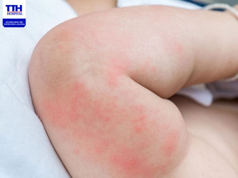 Da trẻ cần được vệ sinh sạch sẽ và nhẹ nhàng mỗi ngày tránh bị rôm sảy