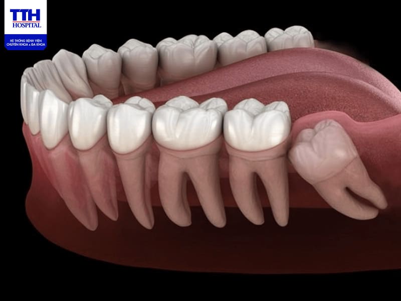 Dấu hiệu mọc răng khôn