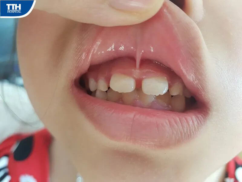 Dấu hiệu nhận biết dính phanh môi trên ở trẻ em