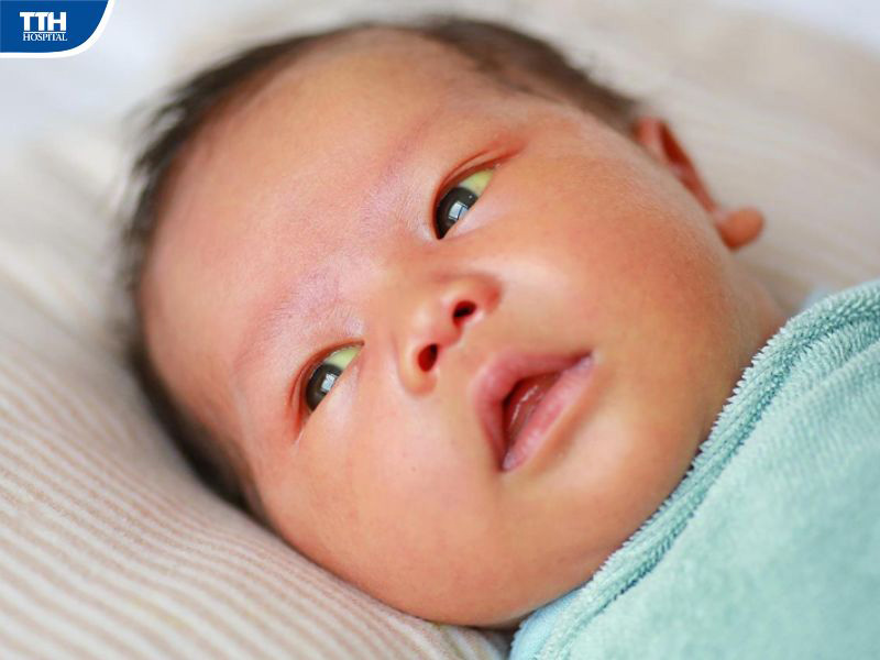Đề phòng vàng da bệnh lý ở trẻ sơ sinh