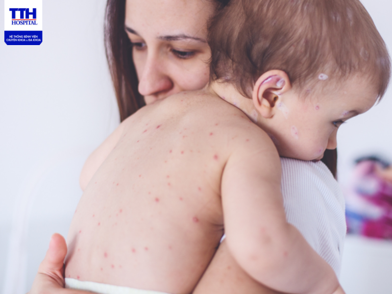 Điều trị bệnh Kawasaki thường mất thời gian khá dài 