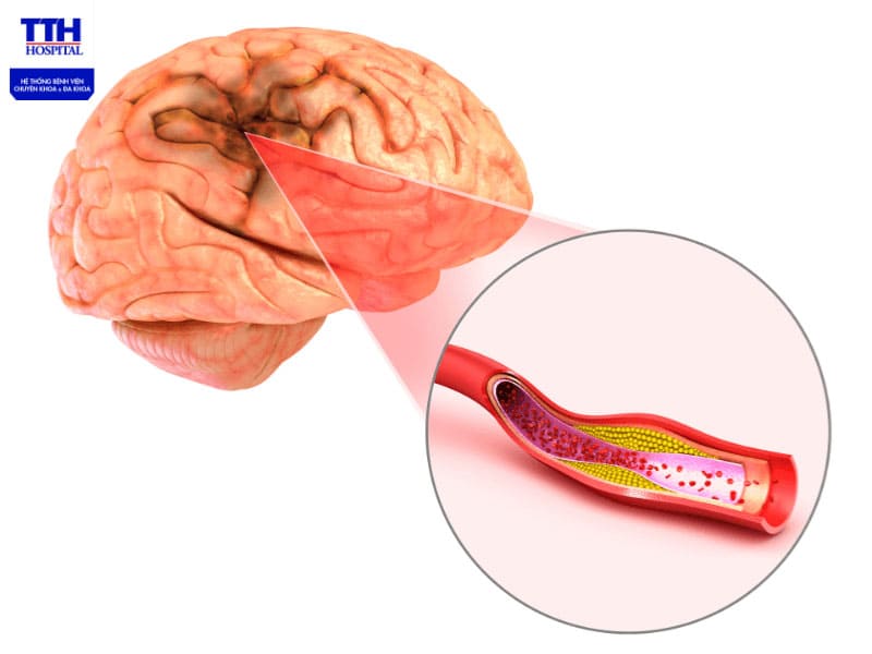 Đột quỵ (tai biến mạch máu não) là một tình trạng cấp cứu y tế nghiêm trọng