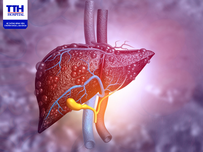 Điều trị gan nhiễm mỡ cần kiên trì và luôn theo dõi tình trạng bệnh 