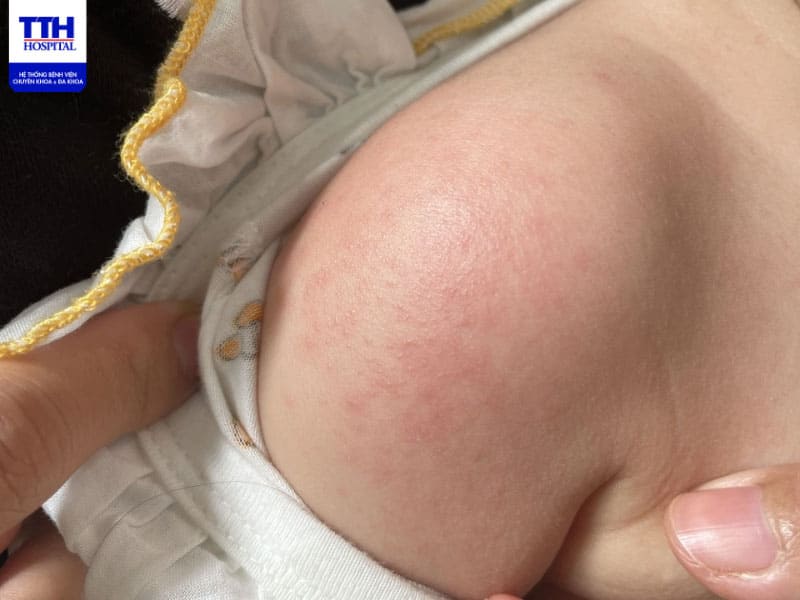 Hãy đến ngay các cơ sở y tế uy tín để thăm khám và điều trị rôm sảy kịp thời