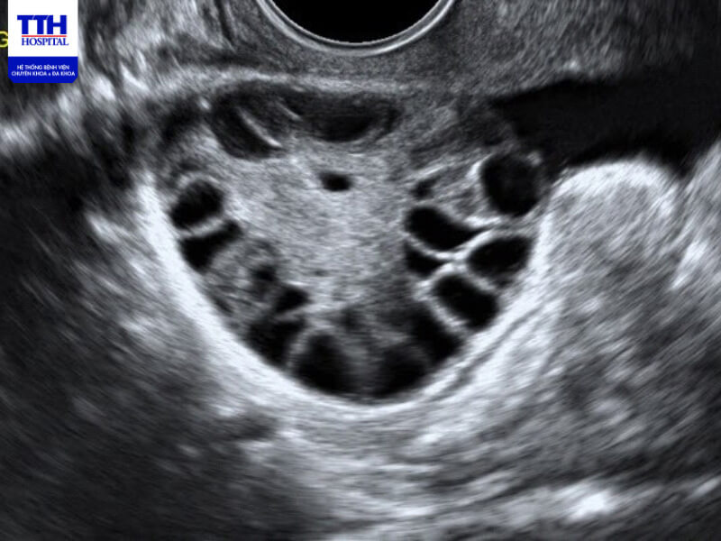 Hình ảnh buồng trứng đa nang được phát hiện trong siêu âm
