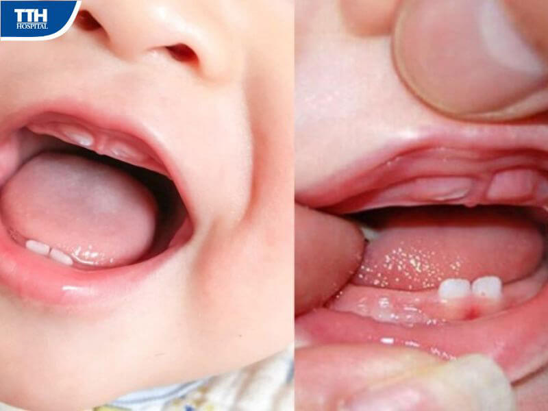 Hướng dẫn chăm sóc trẻ sau khi cắt thắng môi trên