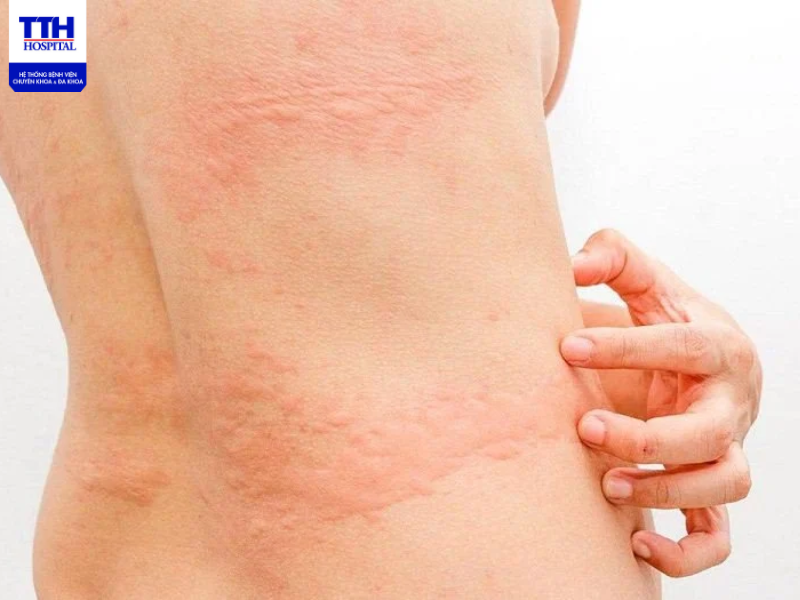 Mề đay là một bệnh thường gặp và cũng gây ngứa ngáy, đau bỏng rát khó chịu cho người bệnh