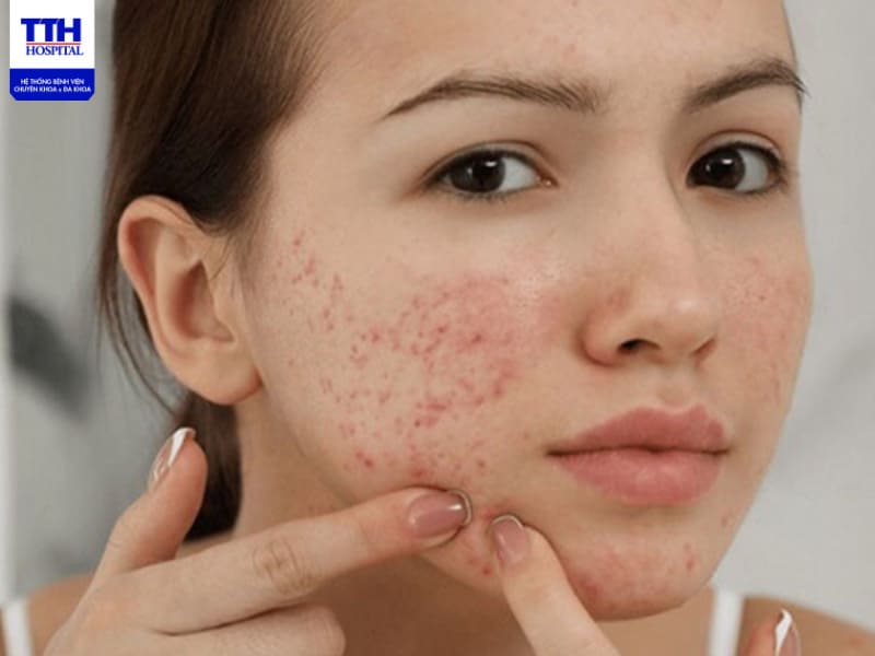  Mụn trứng cá gây mất thẩm mỹ, và khiến người bệnh khó chịu, tự ti