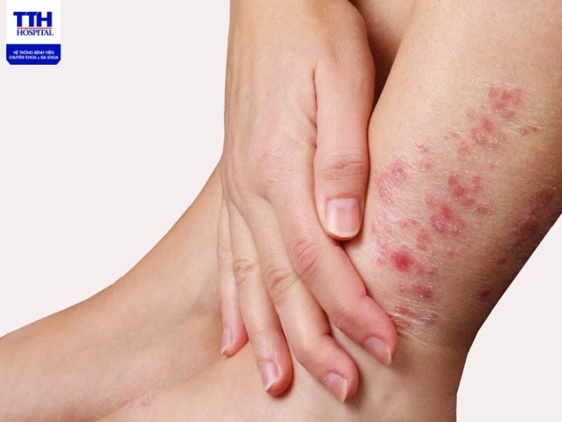 Viêm da tiếp xúc làm vùng da dễ bị tổn thương và sưng đỏ, ngứa rát