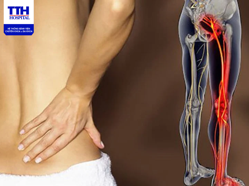 Điều trị đau thần kinh tọa khá phức tạp và lâu dài nên phải có phác đồ điều trị phù hợp