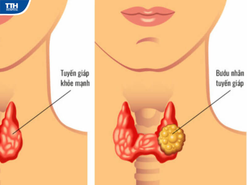 Nguyên nhân khởi phát bệnh viêm tuyến giáp