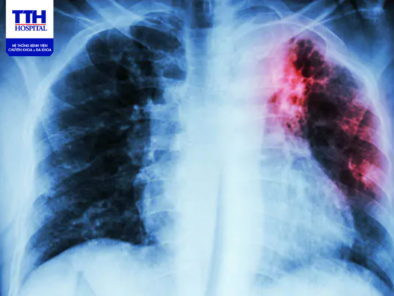 Phương pháp điều trị lao phổi phổ biến là dùng kết hợp kháng sinh tối thiểu 6 tháng