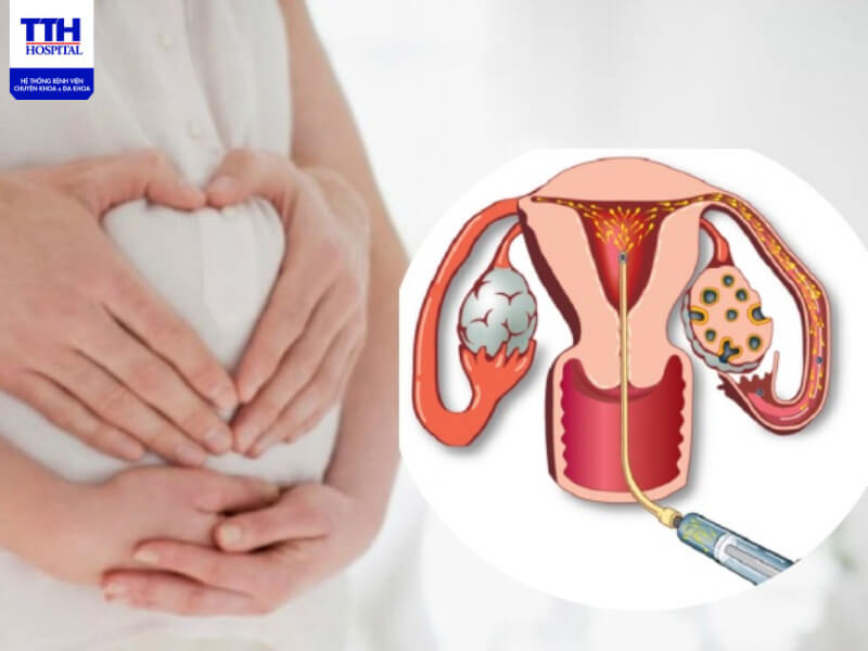 PCOS ảnh hưởng tới khả năng sinh sản, người mắc bệnh này vẫn có thể sinh con bình thường