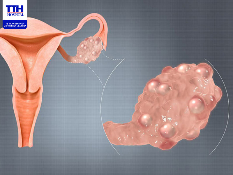 pcos-anh-huong-toi-kha-nang-sinh-san-nguoi-mac-benh-nay-van-co-the-sinh-con-binh-thuong