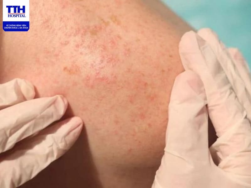 Rôm sảy thường hay xảy ra mùa nóng gây châm chích, khó chịu