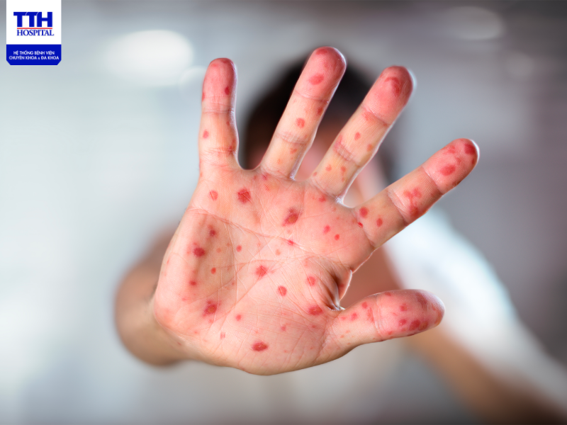 Bệnh sởi là bệnh truyền nhiễm gây dịch lưu hành phổ biến ở trẻ em