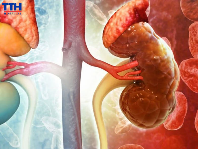 Suy thận là tình trạng chức năng lọc và bài tiết của thận không còn hoạt động tốt như bình thường