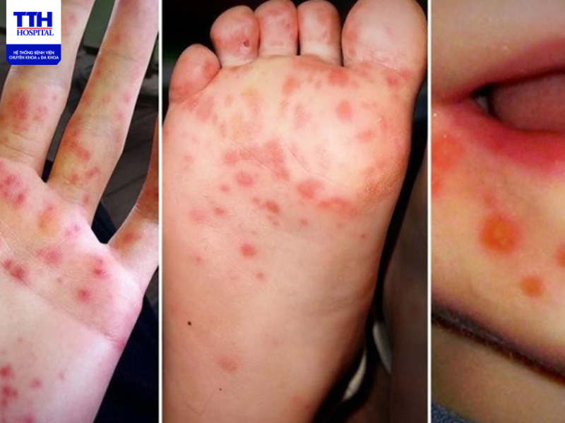 Tay chân miệng là căn bệnh truyền nhiễm cấp tính
