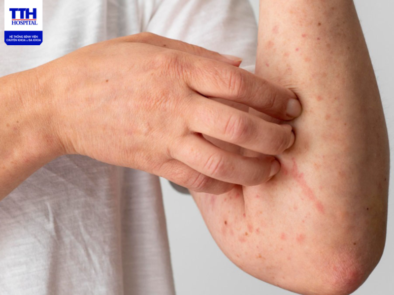 Viêm da cơ địa là một trong những bệnh lý ngoài da thường gặp nhất