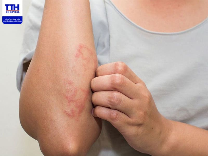 Viêm da tiếp xúc làm vùng da dễ bị tổn thương và sưng đỏ, ngứa rát