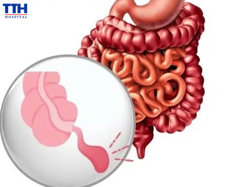 Viêm ruột thừa cấp là một tình trạng cấp cứu ngoại khoa phổ biến