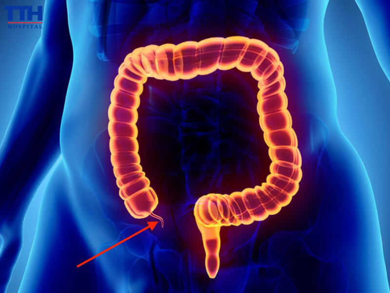 Viêm ruột thừa cấp tính do tác động của tác nhân gây nhiễm trùng