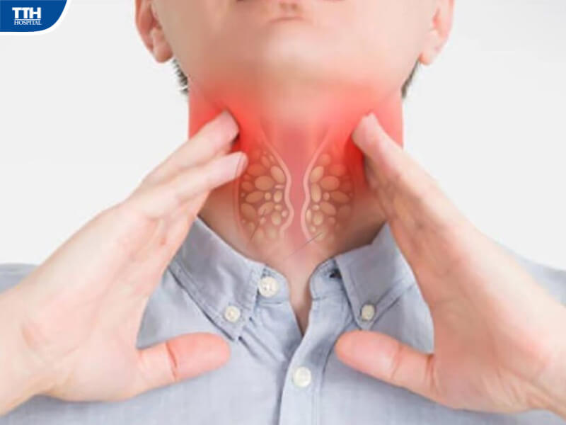 Viêm tuyến giáp là gì