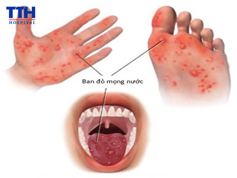 Bệnh tay chân miệng