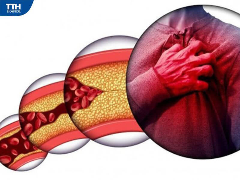 Biến chứng nguy hiểm nếu không kiểm soát mỡ máu cao