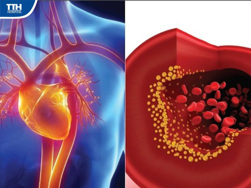 Các phương pháp chẩn đoán mỡ máu cao