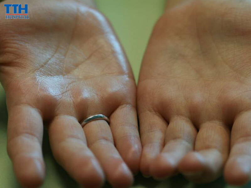 Cách điều trị bệnh tăng tiết mồ hôi