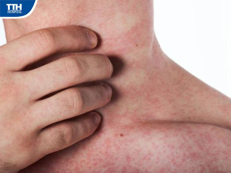 Dấu hiệu nhận biết sớm sốt xuất huyết