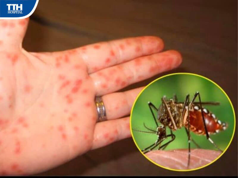 Hướng dẫn theo dõi sốt xuất huyết tại nhà