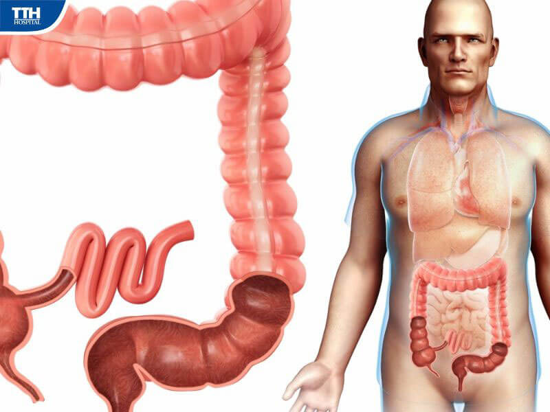 Nguyên nhân gây tắc ruột ở người già