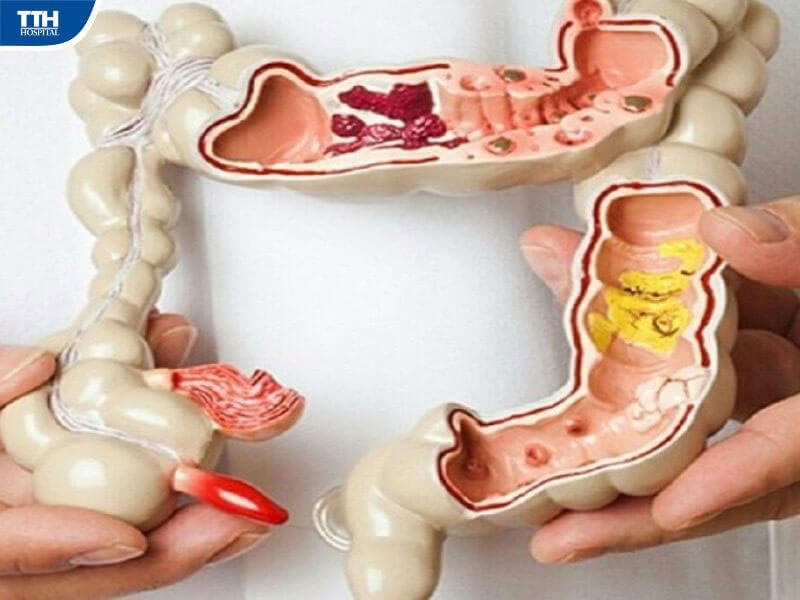 Những biến chứng khi người già bị tắc ruột