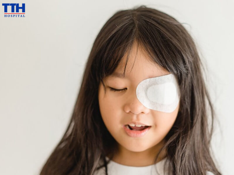 Nhược thị (mắt lười)