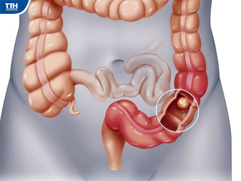 Phương pháp phòng ngừa tắc ruột ở người già