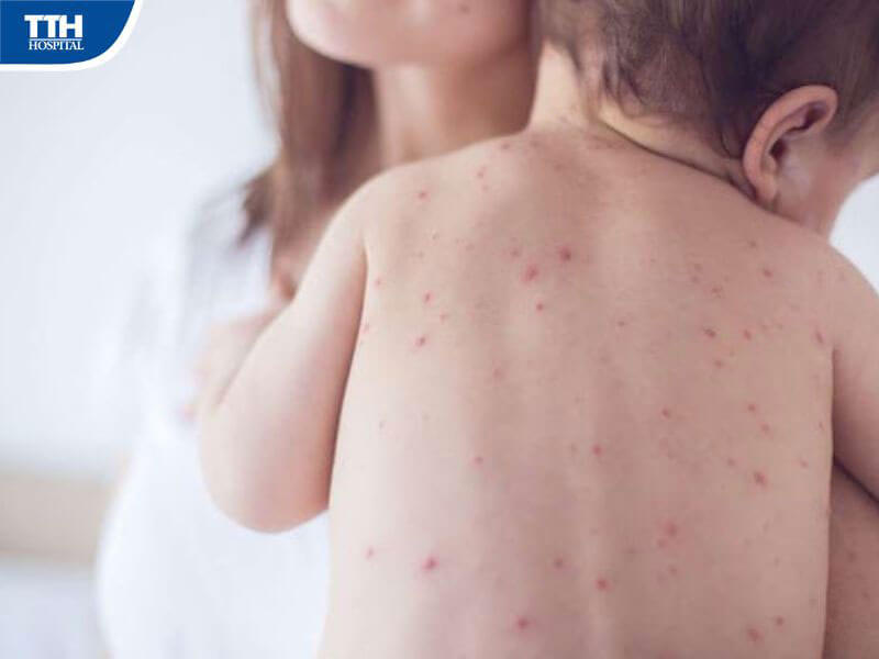 Sốt xuất huyết là bệnh gì?