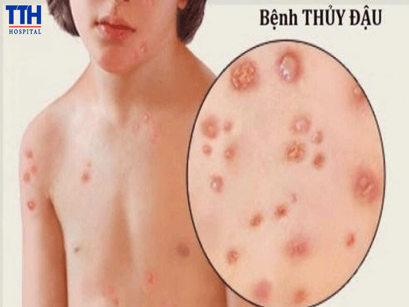 Thủy đậu