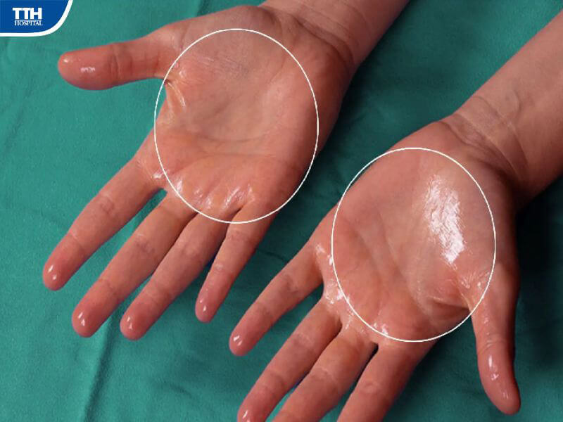 Triệu chứng nhận biết bệnh tăng tiết mồ hôi