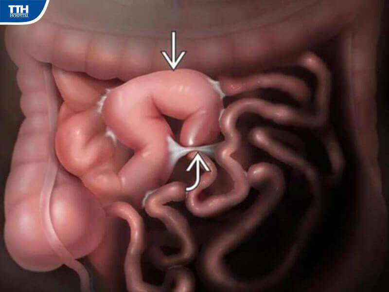 Triệu chứng nhận biết bệnh