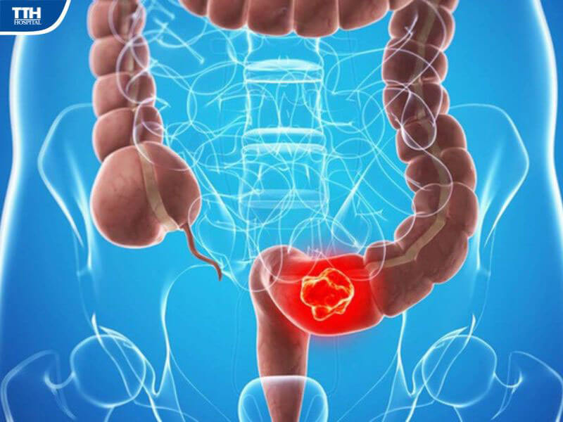 Ung thư đại trực tràng